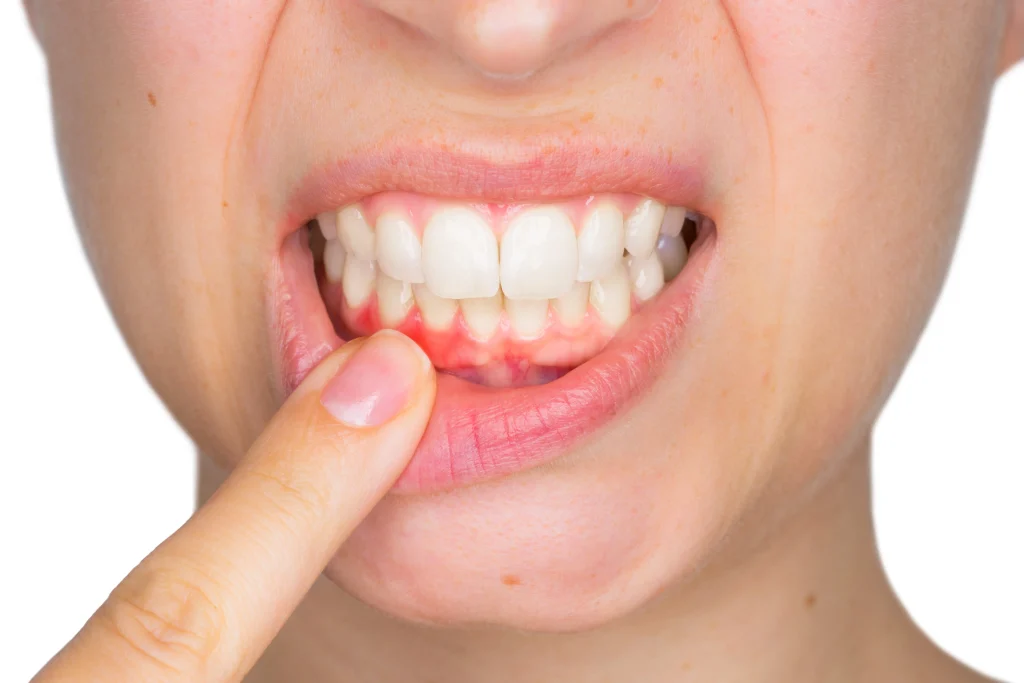 Can Gum Disease Lead to Tonsillitis? Understanding the Link Between Periodontitis and Throat Infections